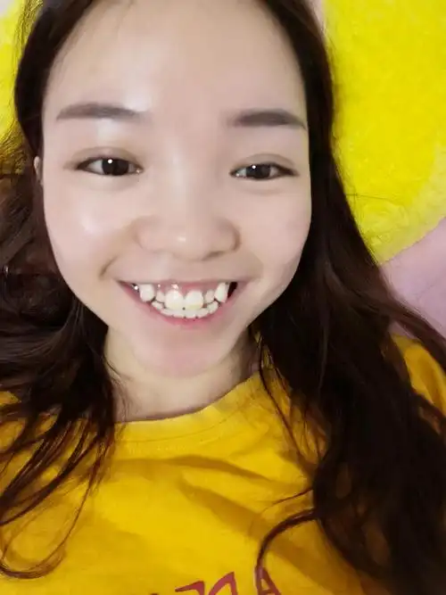 28岁了,巨大的虎牙有必要戴牙套吗