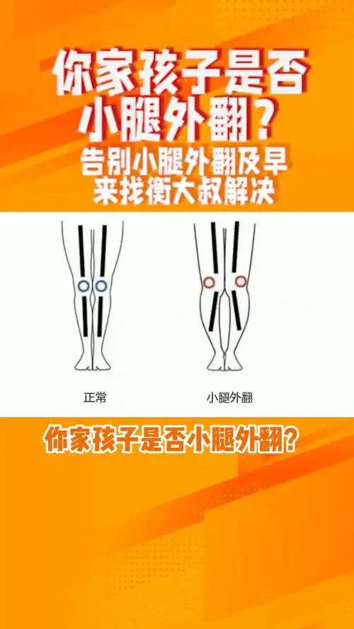步步衡儿童定制鞋垫: 你家孩子是否有小腿外翻,不要错过最佳的纠正