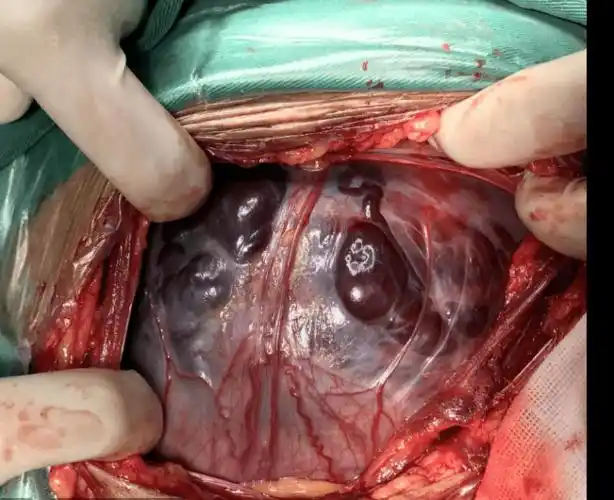 商丘市立医院第一例凶险型前置胎盘手术顺利完成