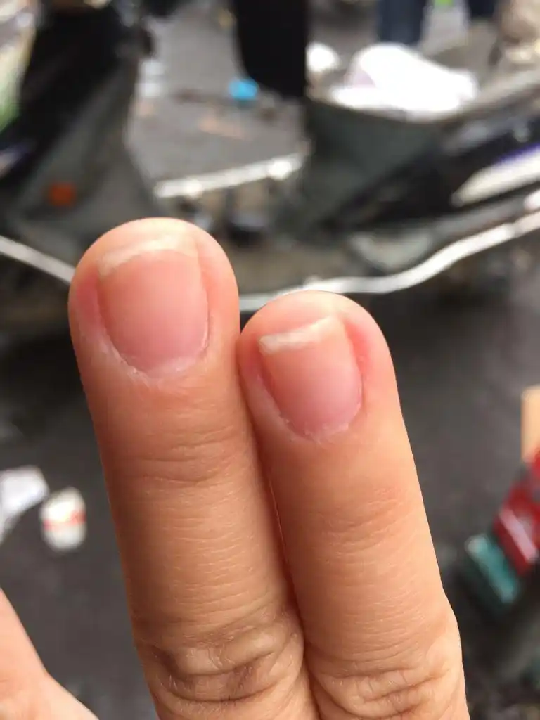 问: 10 指甲分层了,看这挺恐怖了.