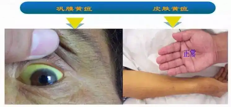 从症状谈疾病系列——黄疸