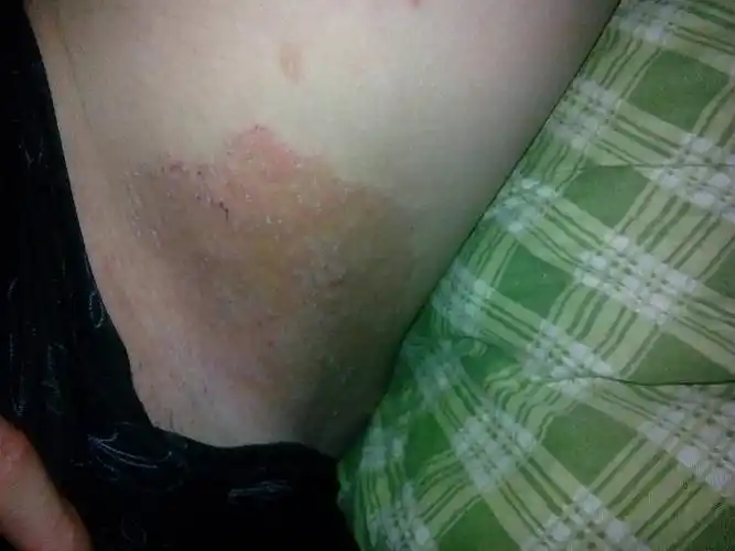 请问这个是股癣吗,都是红颜色的疙瘩,还很痒