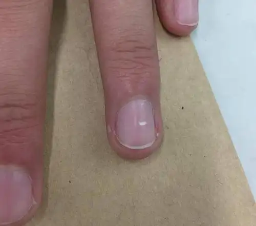 指甲莫名其妙有了白点根本不需要担心