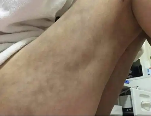 女子在南昌亚太医疗美容医院做抽脂术后惨不忍睹腿疼凹陷淤青