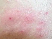 血热导致的月经后期屡见不鲜,并随着社会节奏及生活习惯的改变,其发病