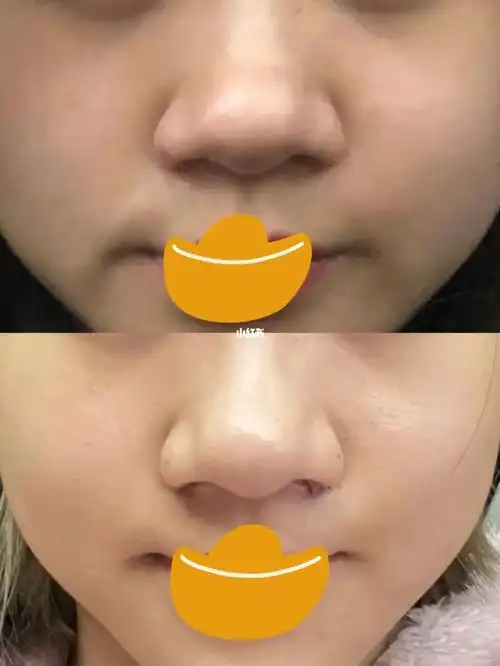 也不敢去do鼻子,怕打麻药,最大限度就是缩鼻翼.