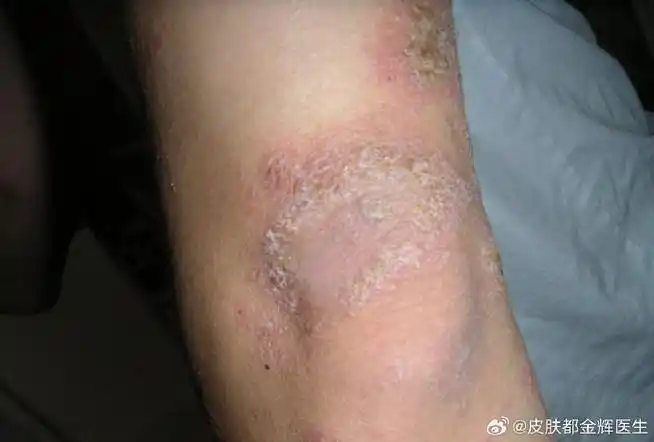 原发性一般会出现丘疹,水泡,继发性中多呈现有糜烂,渗出,一般湿疹患者