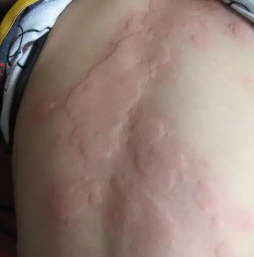 东莞最专业皮肤过敏医院