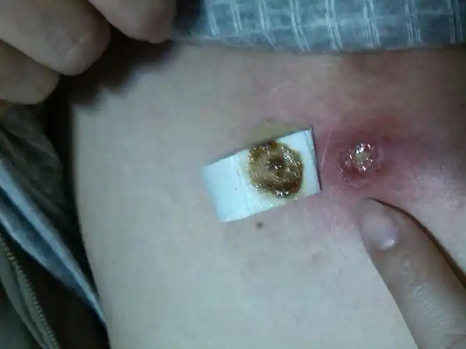 急求诊:朋友皮肤上长有象暗疮样的小红点,后变成溃烂状皮肤疮,周有