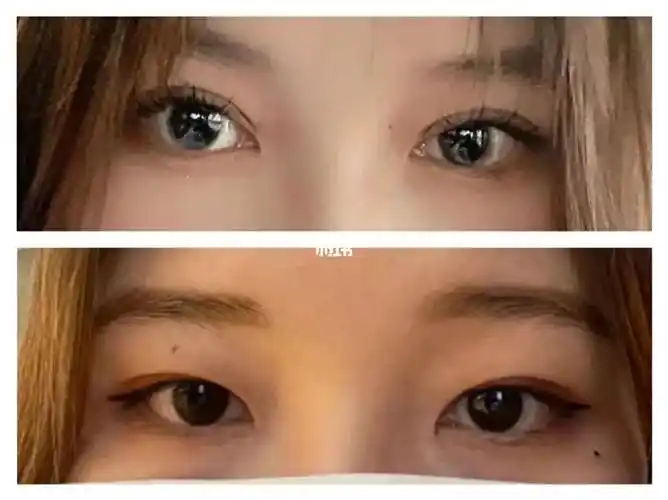 全切双眼皮对比