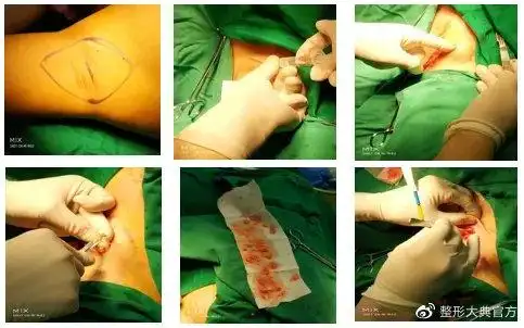 刘黎明硝酸甘油软膏在小切口腋臭根治术后中的临床应用丨专业视点