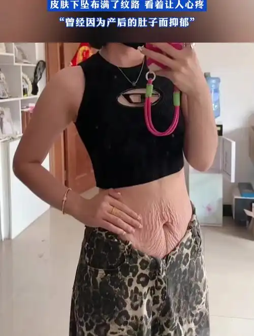 女生晒生完孩子的肚子,皮肤下坠布满了纹路 看着让人心疼-度小视