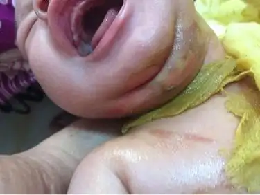 宝宝被开水烫伤了懂的宝妈枝枝意见