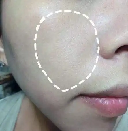 干燥肌肤毛孔粗大,皮肤表面缺水的话,皮肤的角质层会干燥,皮肤粗糙