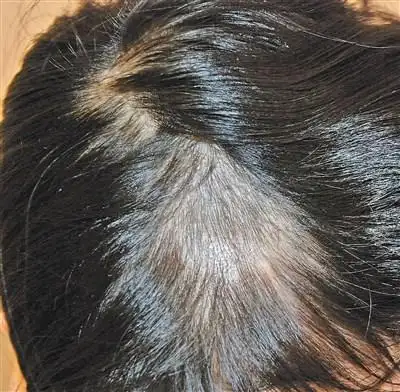 头皮癣早期症状图片5