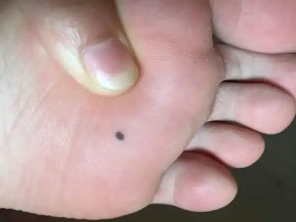 你们脚底有痣吗?要不要去切掉?