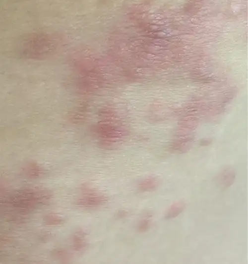 产后湿疹怎么办?擦药膏还是会长新的,全身都有,很痒,宝宝42天,哎