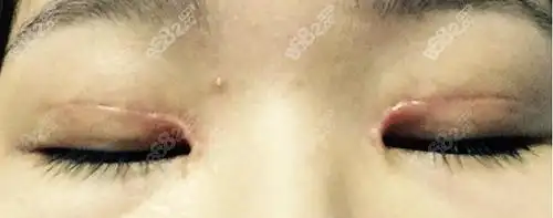 原来双眼皮失败有6大表现,对应修复方法必须掌握!