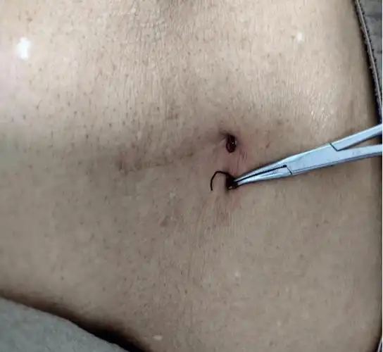 出现这种情况到伤口造口门诊来就诊 | 健康科普_反应_患者_排异