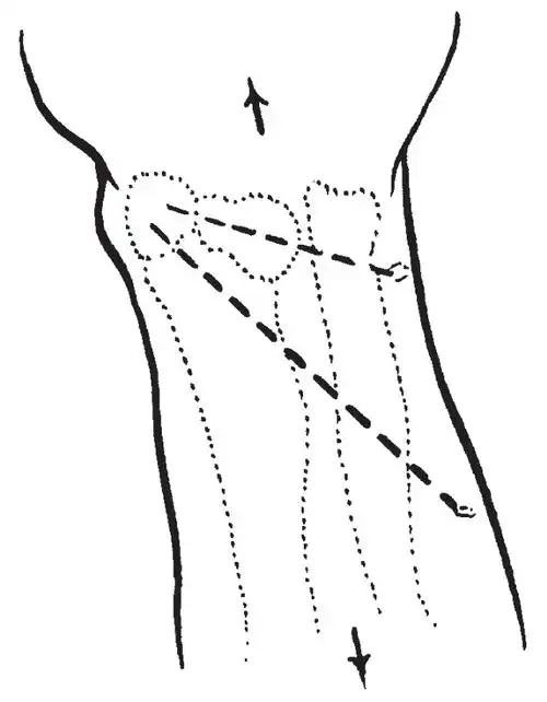 先行手法牵引与反牵引,然后使腕关节掌屈尺偏,术者用拇指向掌,尺侧推