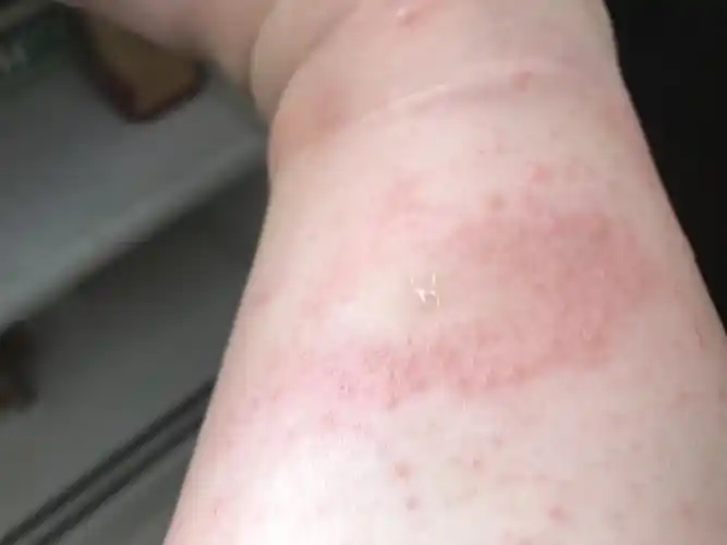 我腿上起的是热疙瘩 还是湿疹