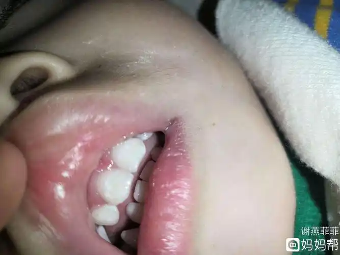 宝宝牙齿脱矿这两天掉了一小块好心塞啊