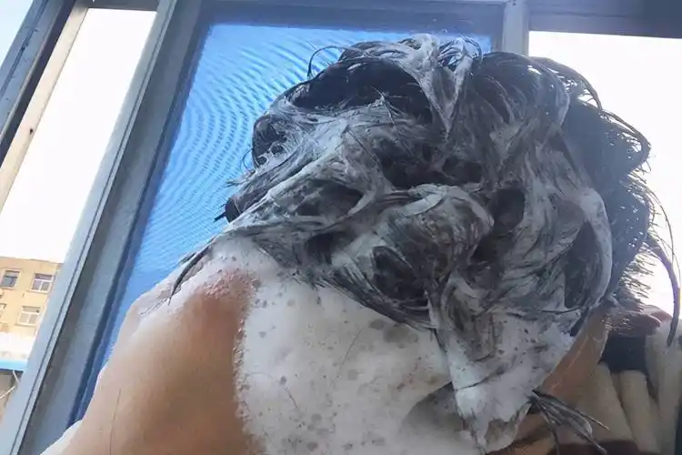 头皮痒怎么办头皮特别痒还有疙瘩