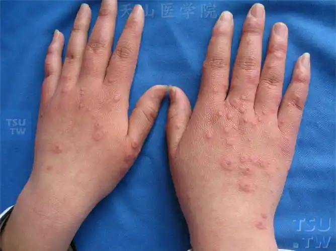 多形红斑erythemamultiforme的症状表现