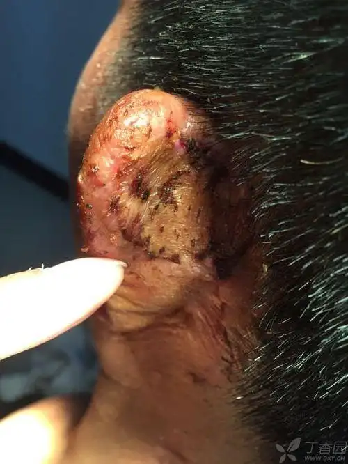 【讨论】耳后基底细胞癌一例. [病例帖]