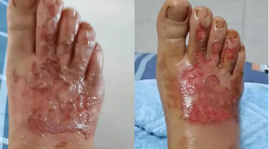 (作者脚面被烫伤的照片)