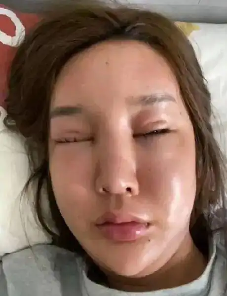 网红因整容过多直接毁容脸部凹陷畸形严重神经受损成面瘫