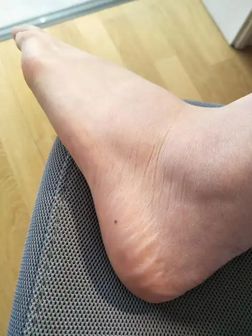 很接近脚底的痣要去处理吗