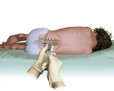 腰椎穿刺术操作流程