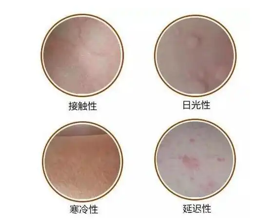 荨麻疹初期症状图片,急性有风团瘙痒还可发热(100种皮肤病对照图片)