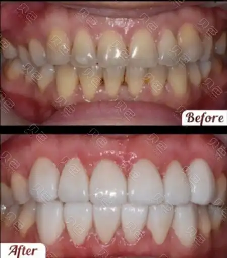 贴面前后对比图