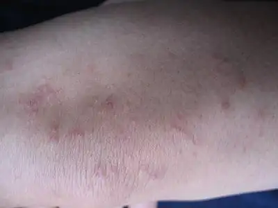 鱼鳞病症状有哪些是常见的