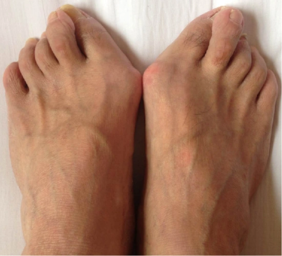 i度:外翻的脚拇趾与其它的脚趾不发生挤压