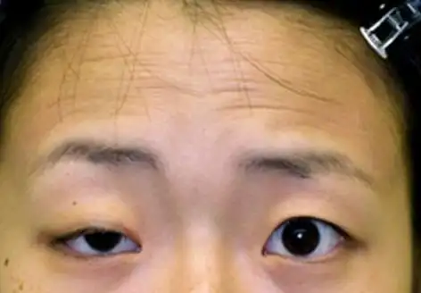 重症眼睑下垂怎么办?