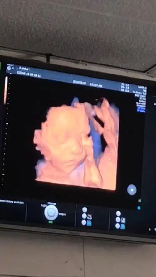 四维一次通过,医生说宝宝高鼻梁