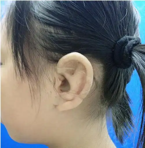 小儿马方综合征是常染色体显性遗传病多数患者在50岁前死亡