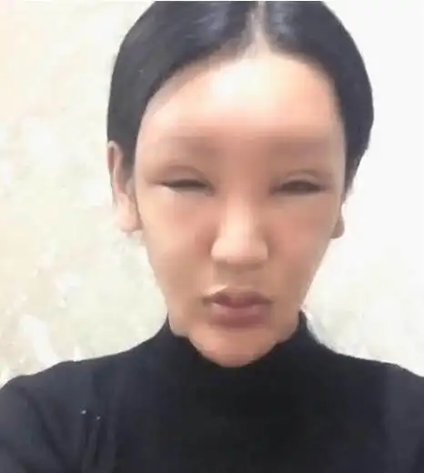知名网红脂肪填充失败,因审美畸形变成"蛇精脸"