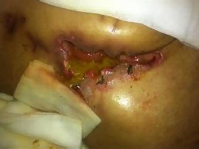 直肠癌的早期症状与临床表现图片