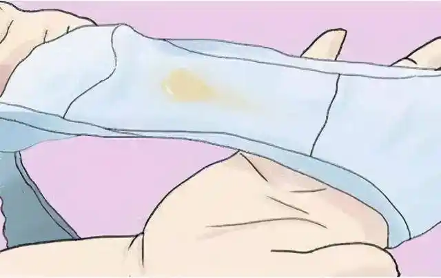 女性分泌物出现4个异常或是宫颈病变了且一个比一个严重