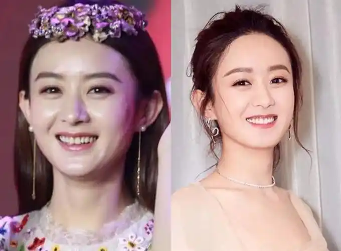 一向走甜美路线的赵丽颖,也曾经被牙黄拖了后腿;做了牙齿美白后,气质