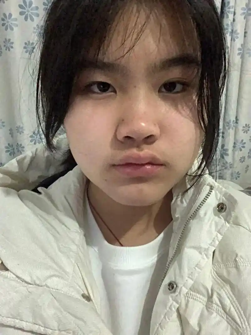 可是原相机的我真的好丑啊 满脸的痘痘 鼻子上的黑头 大蒜鼻  - 抖音