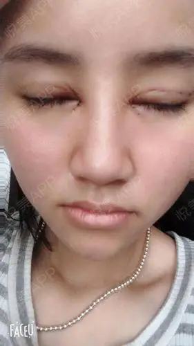 埋线双眼皮 开内眼角 术后1天