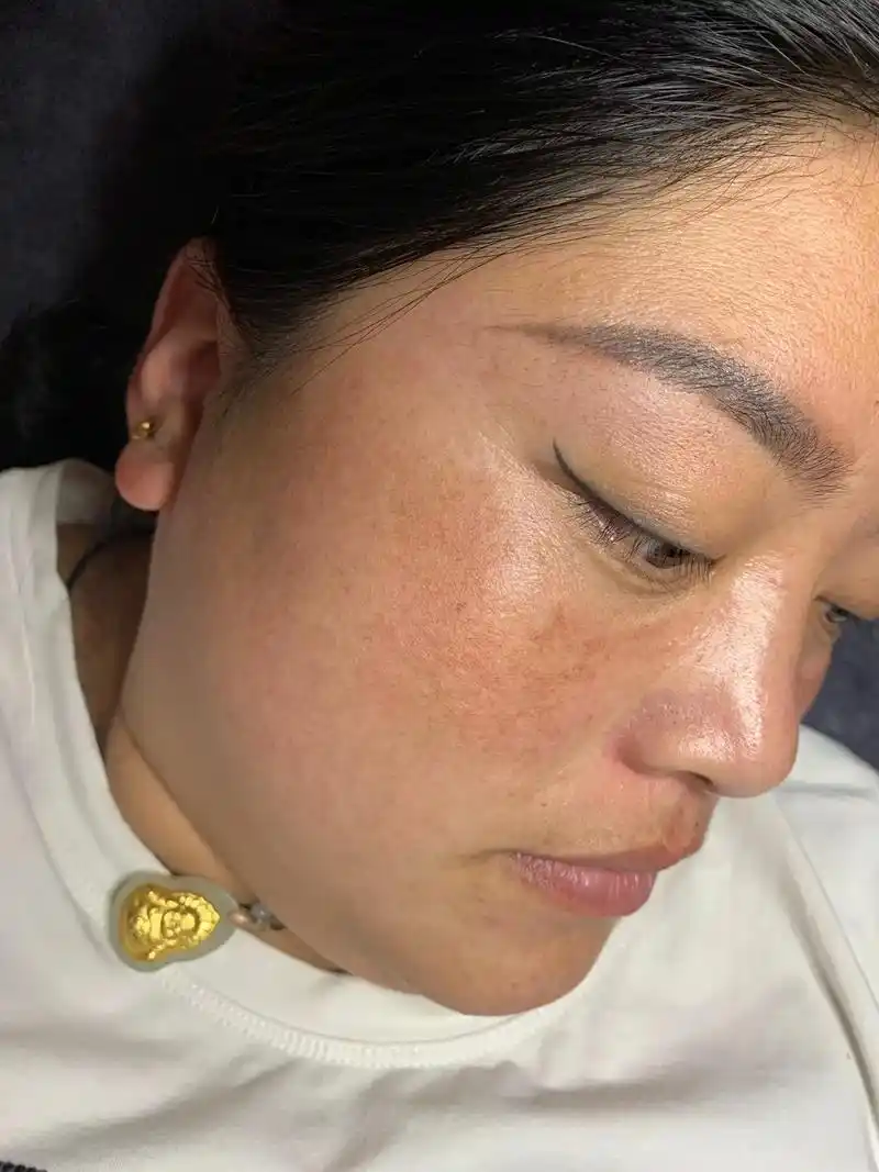 美女祛黄褐斑半年后的皮肤状态