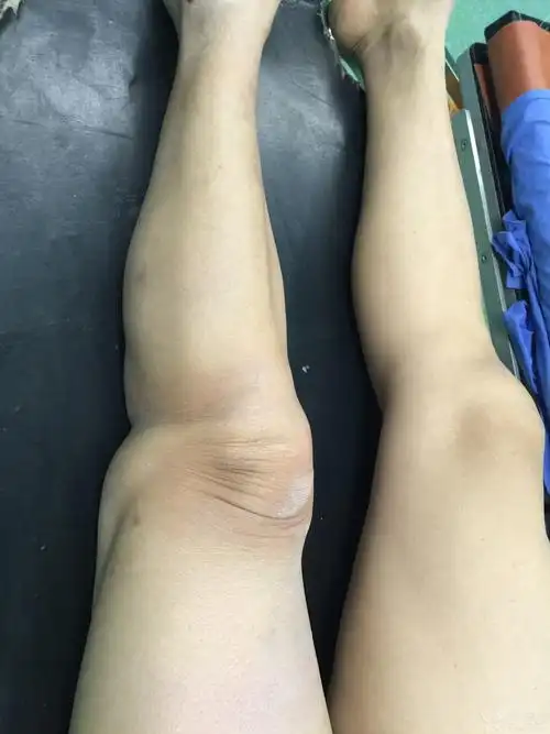 辅助检查:x线片:左膝关节脱位