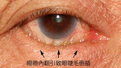 眼睑内翻