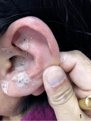 观耳识疾病贴耳促健康